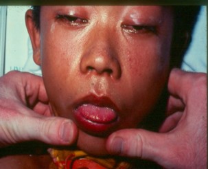 Figure.C.16: Signs of drooping eyelids, eyes standing in the center, flaccid paralysis, symmetry due to Tiger snake venom.
