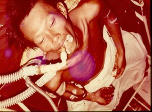 Figure.C.17: Patient with neuromuscular toxicity, acute respiratory failure, mechanical ventilation due to Earth Tiger snake venom.