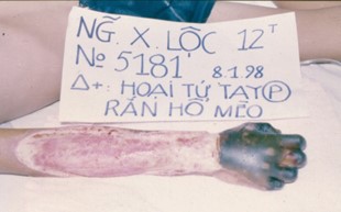 Figure.C.19: Patient with deep-wide arm necrosis due to cobra venom, at Cho Ray Hospital.